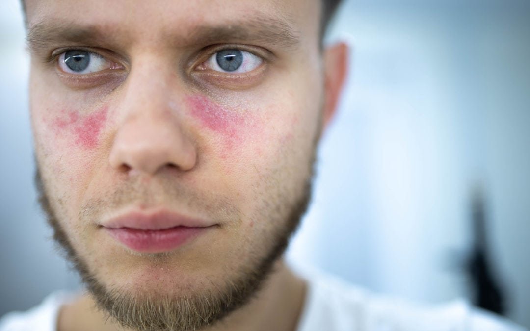 Neue Therapie zeigt Erfolge bei Bekämpfung der Autoimmunerkrankung Lupus